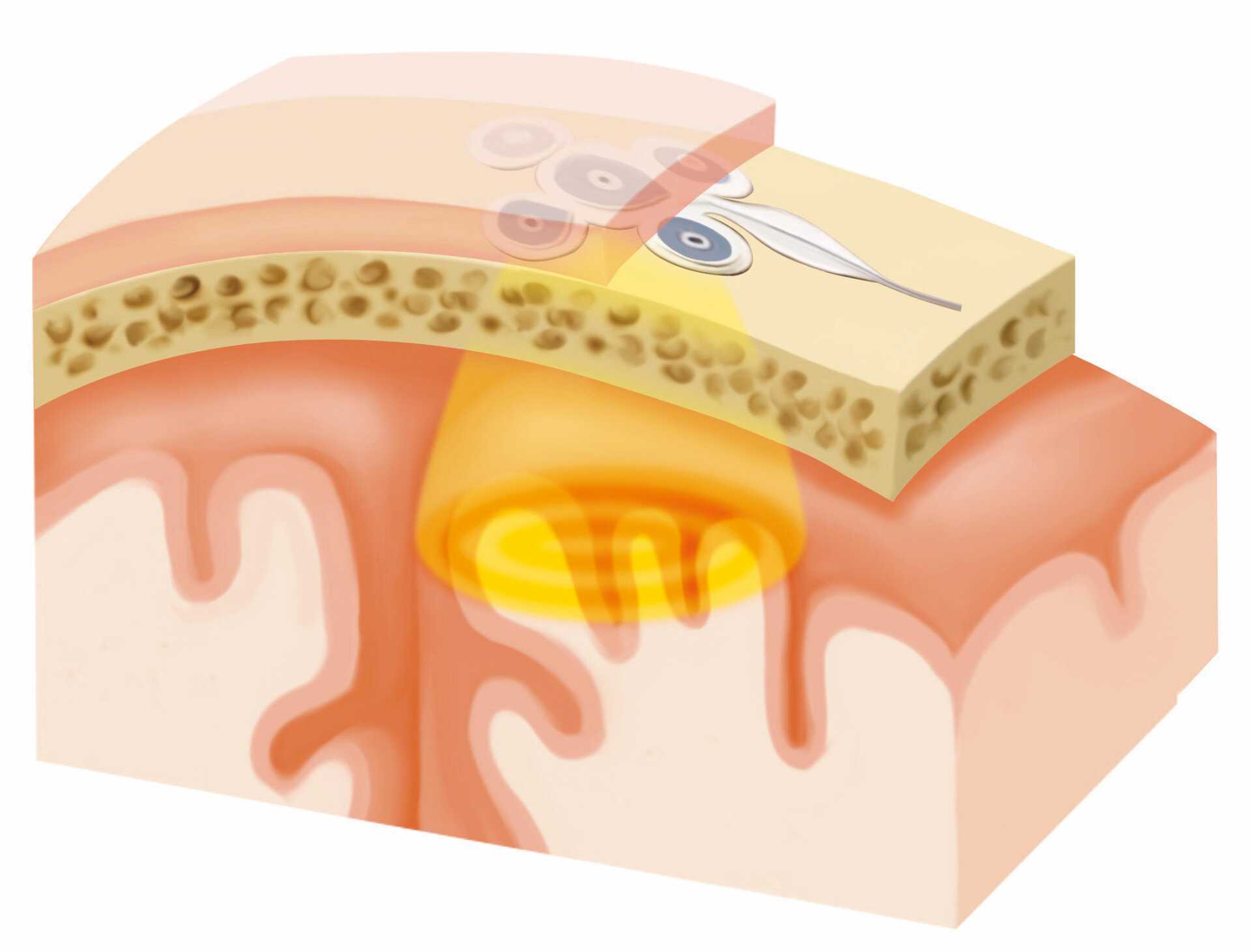 Schichtenaufbau Implantat